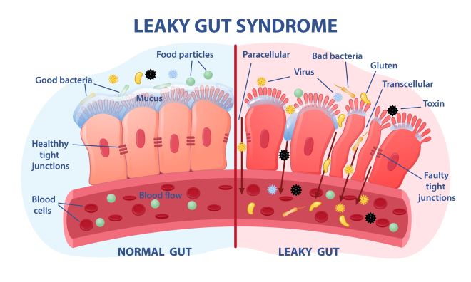 leaky gut syndrome - Toledo, OH